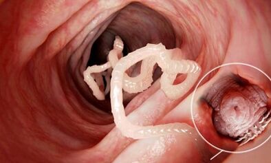 How to identify the presence of parasites in the human intestine