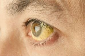 Whites of eyes turn yellow